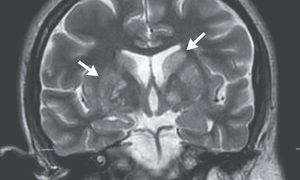 Case 40-2020: A 24-Year-Old Man with Headache and Covid-19
