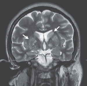 Case 40-2020: A 24-Year-Old Man with Headache and Covid-19