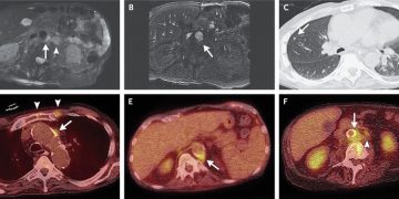 Case 5-2021: A 68-Year-Old Man with Delirium and Renal Insufficiency