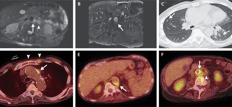 Case 5-2021: A 68-Year-Old Man with Delirium and Renal Insufficiency